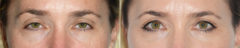 Blepharoplasty (eyelids) Before and After Photos in Miami, FL, Patient 19960