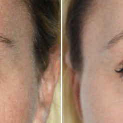 Blepharoplasty (eyelids) Before and After Photos in Miami, FL, Patient 19960