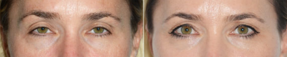 Blepharoplasty (eyelids) Before and After Photos in Miami, FL, Patient 19960