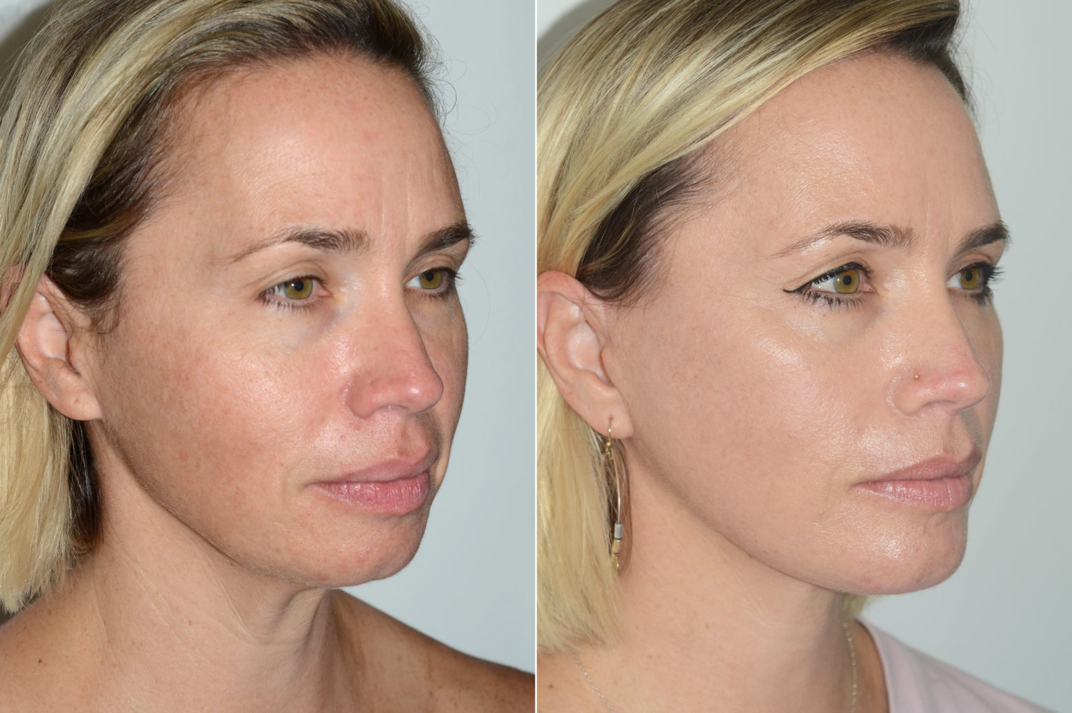 Deep Plane Facelift photos Miami, FL. Patient 19950