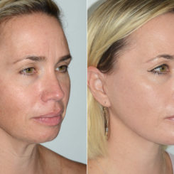 Deep Plane Facelift Before and After Photos in Miami, FL, Patient 19950