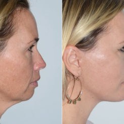 Deep Plane Facelift Before and After Photos in Miami, FL, Patient 19950