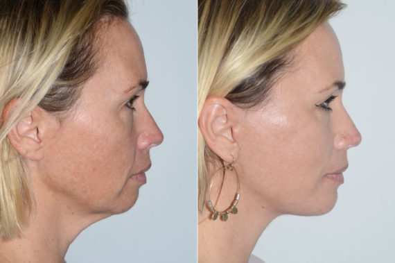 Deep Plane Facelift Before and After Photos in Miami, FL, Patient 19950