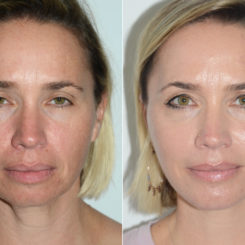 Deep Plane Facelift Before and After Photos in Miami, FL, Patient 19950