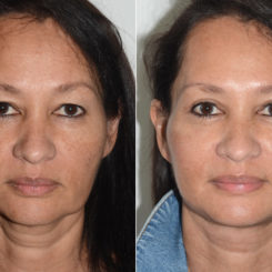Deep Plane Facelift Before and After Photos in Miami, FL, Patient 19982