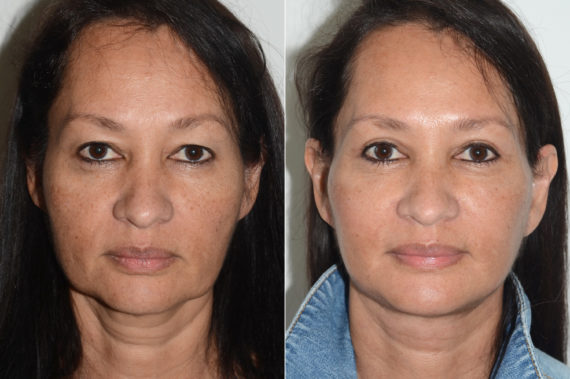 Deep Plane Facelift Before and After Photos in Miami, FL, Patient 19982