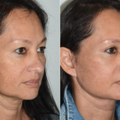 Deep Plane Facelift Before and After Photos in Miami, FL, Patient 19982