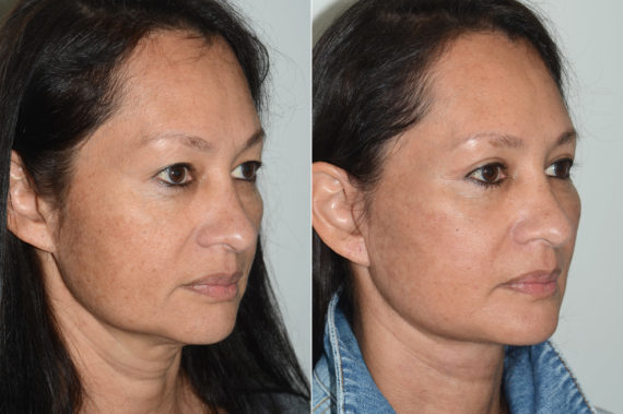 Deep Plane Facelift Before and After Photos in Miami, FL, Patient 19982