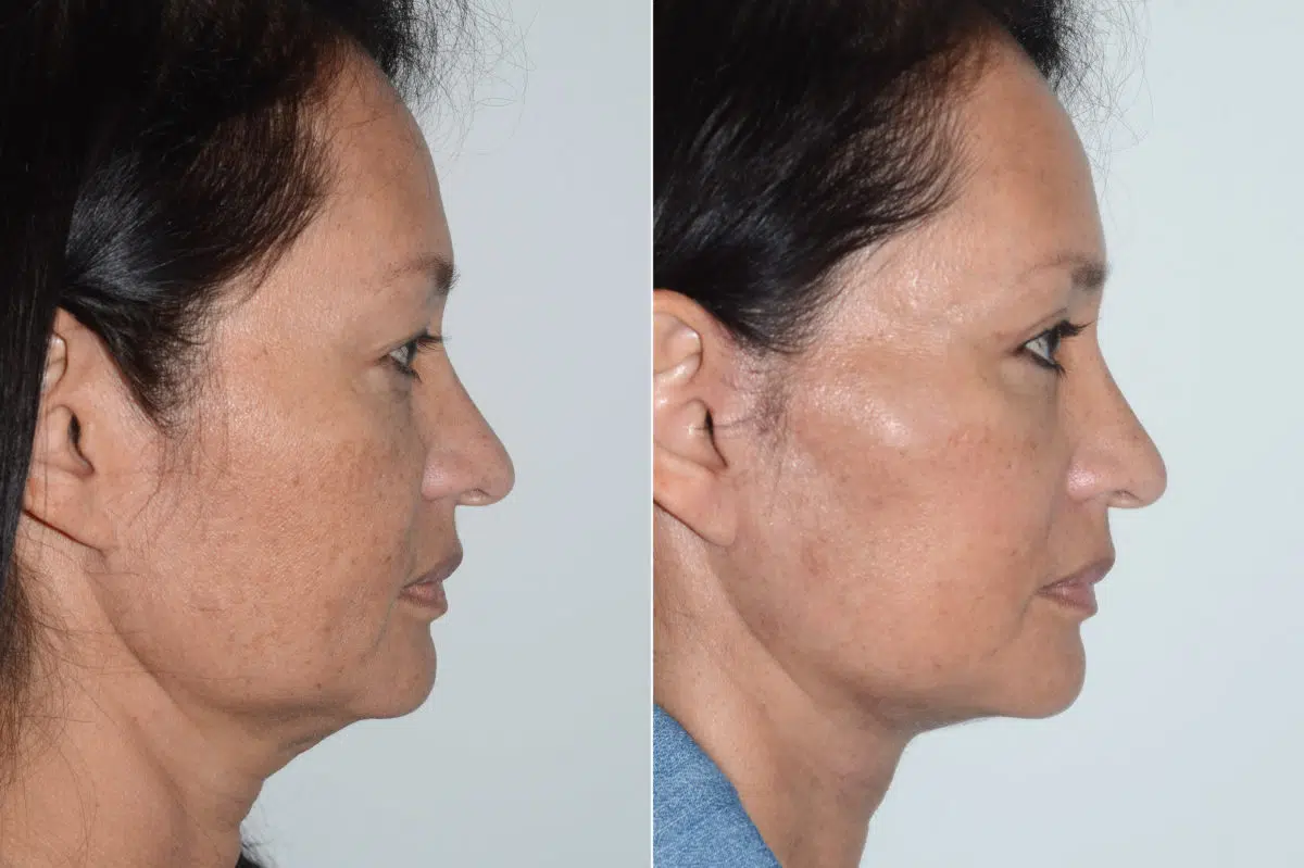 Deep Plane Facelift Before and After Photos in Miami, FL, Patient 19982