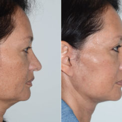 Deep Plane Facelift Before and After Photos in Miami, FL, Patient 19982
