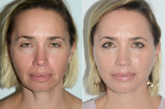 Deep Plane Facelift Before and After Photos in Miami, FL