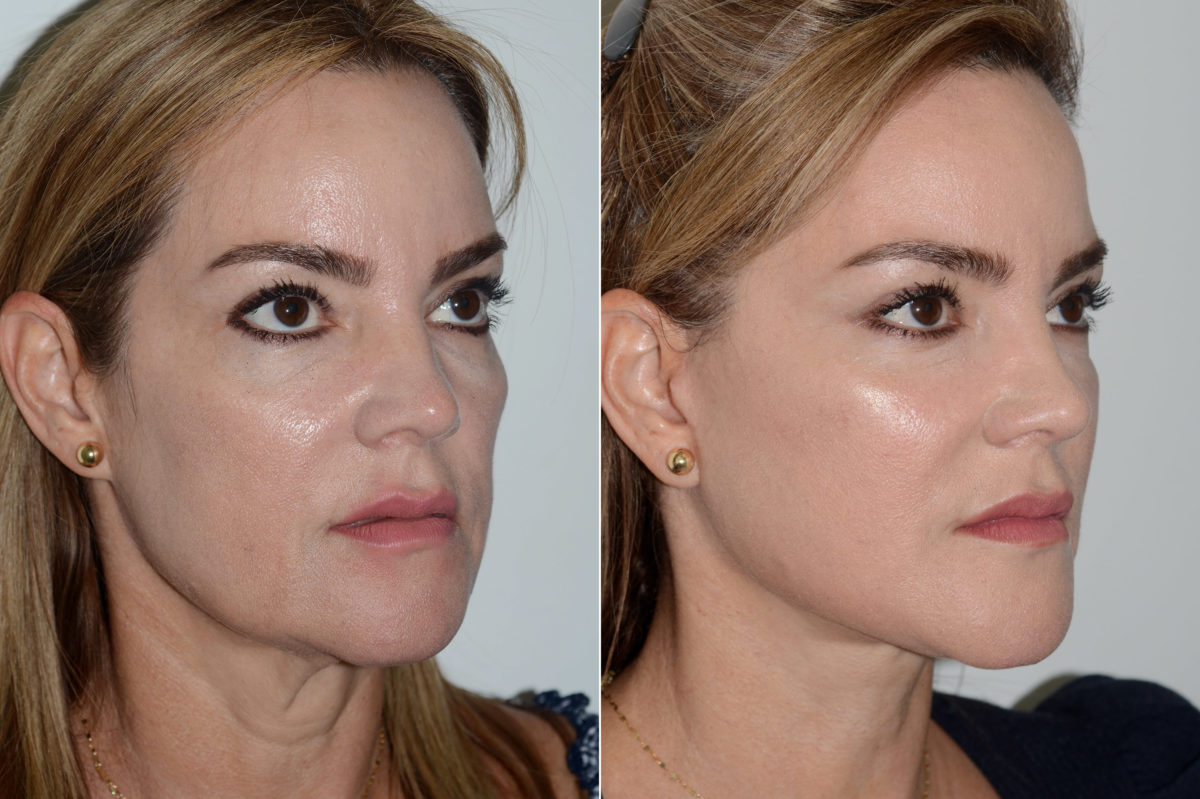 Deep Plane Facelift Before and After Photos in Miami, FL, Patient 20043