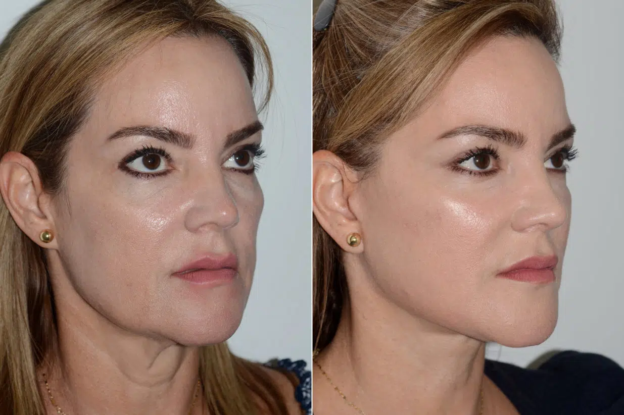 Real patient results of a Facelift in Miami. Before and after photos of a Facelift in Miami.