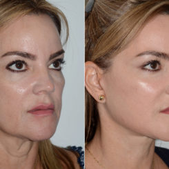 Deep Plane Facelift Before and After Photos in Miami, FL, Patient 20043