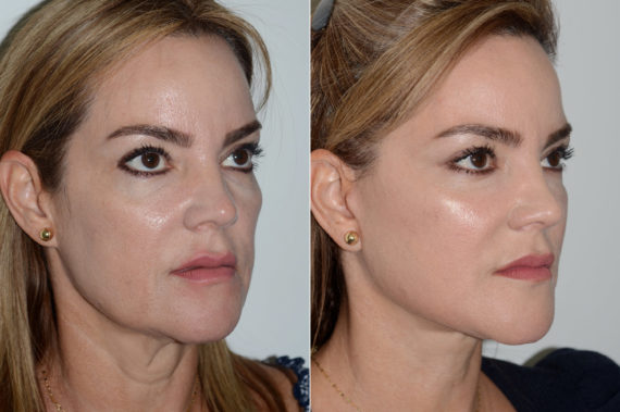 Deep Plane Facelift Before and After Photos in Miami, FL, Patient 20043