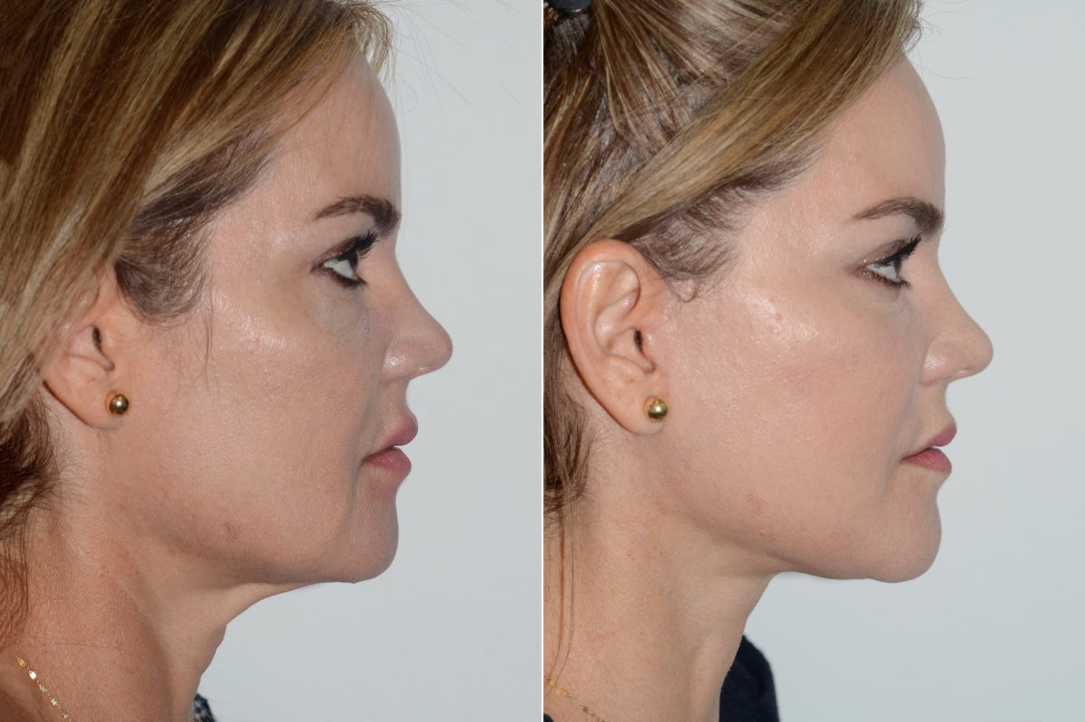 Deep Plane Facelift Before and After Photos in Miami, FL, Patient 20043