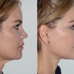 Deep Plane Facelift Before and After Photos in Miami, FL, Patient 20043