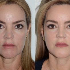 Deep Plane Facelift Before and After Photos in Miami, FL, Patient 20043