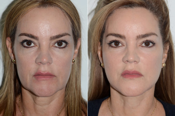 Deep Plane Facelift Before and After Photos in Miami, FL, Patient 20043