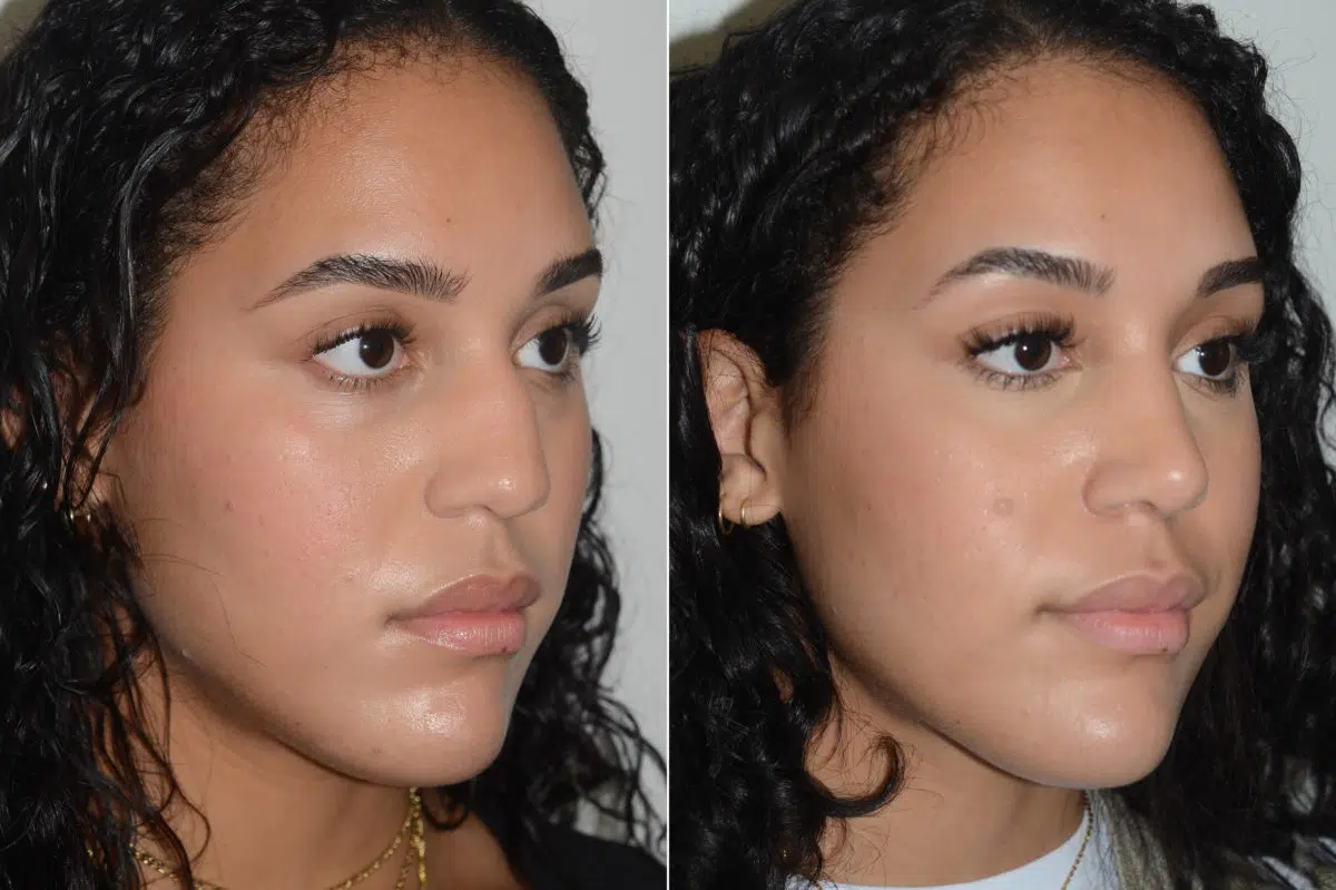 Rhinoplasty Before and After Photos in Miami, FL, Patient 20059