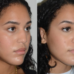 Rhinoplasty Before and After Photos in Miami, FL, Patient 20059