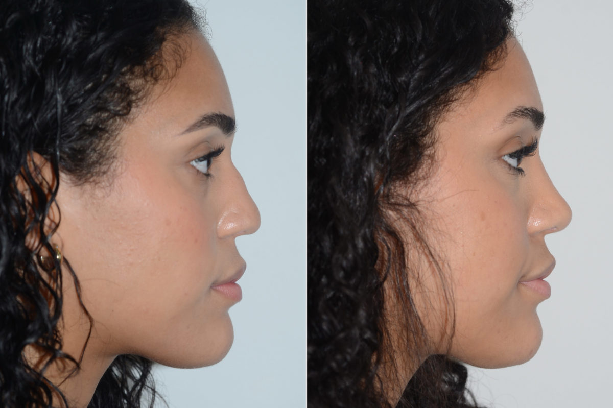 Rhinoplasty Before and After Photos in Miami, FL, Patient 20059