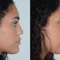 Rhinoplasty Before and After Photos in Miami, FL, Patient 20059