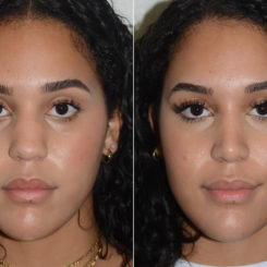 Rhinoplasty Before and After Photos in Miami, FL, Patient 20059