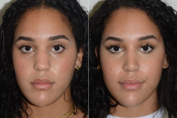 Rhinoplasty Before and After Photos in Miami, FL, Patient 20059