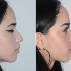 Rhinoplasty Before and After Photos in Miami, FL, Patient 20135
