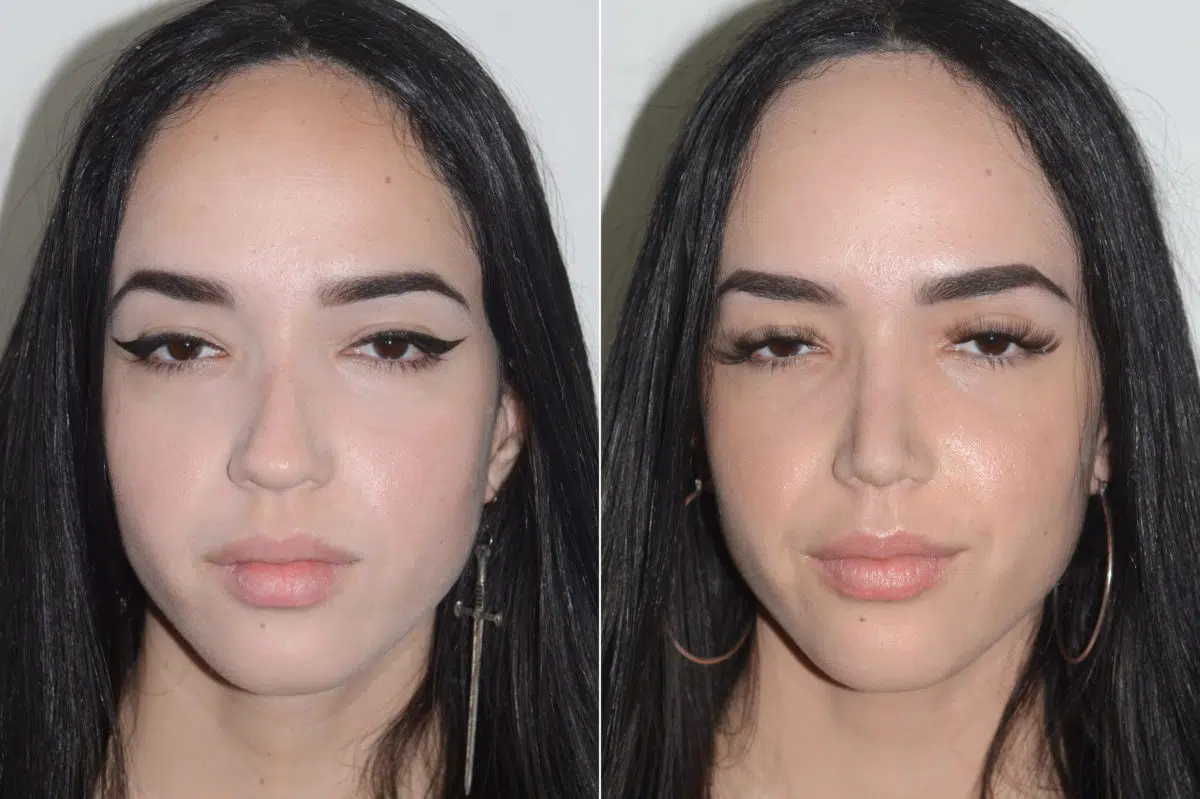 Rhinoplasty Before and After Photos in Miami, FL, Patient 20135