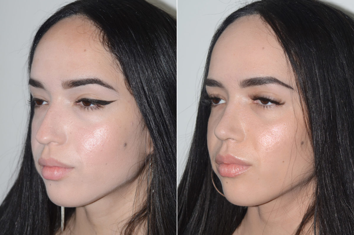 Rhinoplasty Before and After Photos in Miami, FL, Patient 20135