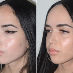 Rhinoplasty Before and After Photos in Miami, FL, Patient 20135