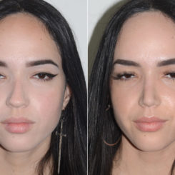 Rhinoplasty Before and After Photos in Miami, FL, Patient 20135