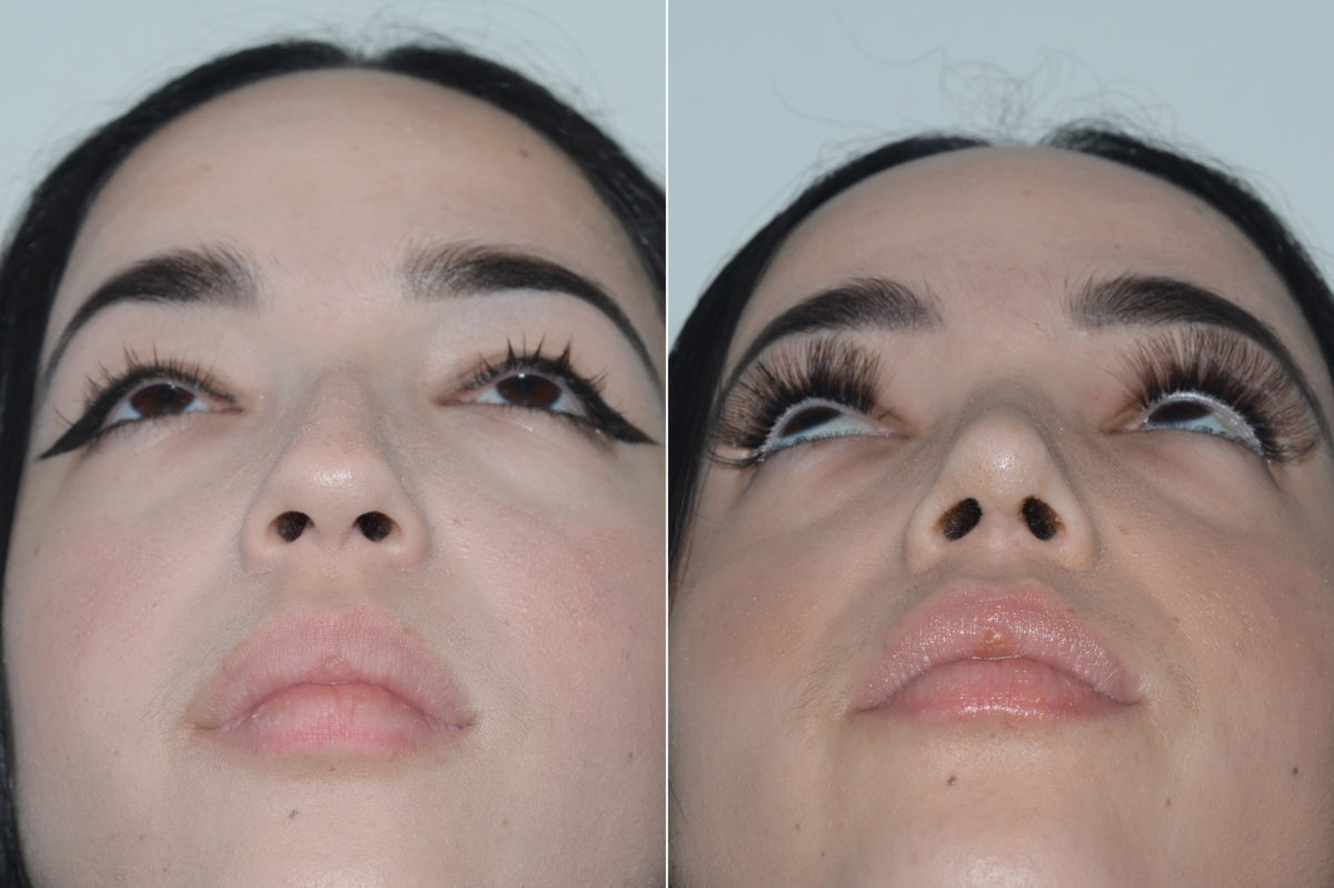 Rhinoplasty Before and After Photos in Miami, FL, Patient 20135
