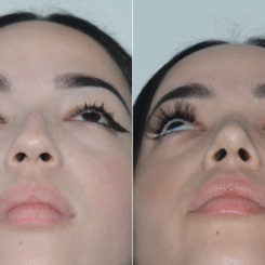 Rhinoplasty Before and After Photos in Miami, FL, Patient 20135
