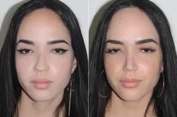 Rhinoplasty Before and After Photos in Miami, FL, Patient 20135