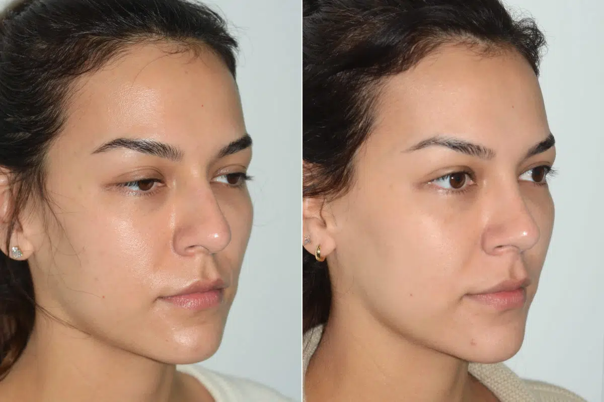 Rhinoplasty Before and After Photos in Miami, FL, Patient 20181