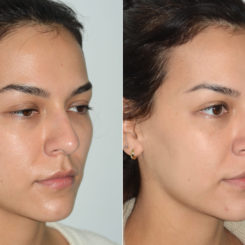 Rhinoplasty Before and After Photos in Miami, FL, Patient 20181