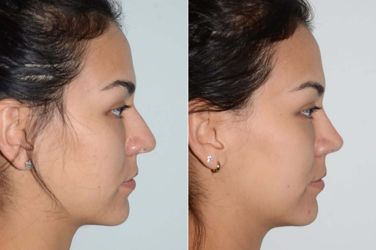 Rhinoplasty Before and After Photos in Miami, FL, Patient 20181
