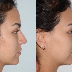 Rhinoplasty Before and After Photos in Miami, FL, Patient 20181