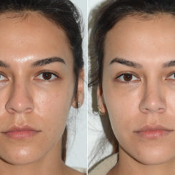 Rhinoplasty Before and After Photos in Miami, FL, Patient 20181