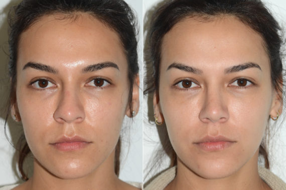 Rhinoplasty Before and After Photos in Miami, FL, Patient 20181