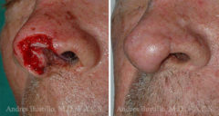 Reconstructive Surgery Before and After Photos in Miami, FL, Patient 15830