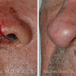 Reconstructive Surgery Before and After Photos in Miami, FL, Patient 15830