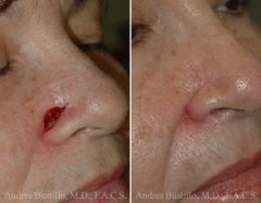 Reconstructive Surgery Before and After Photos in Miami, FL, Patient 15833