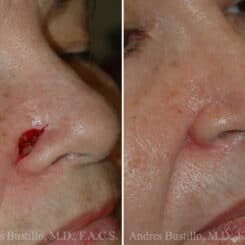 Reconstructive Surgery Before and After Photos in Miami, FL, Patient 15833