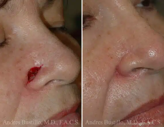 Reconstructive Surgery Before and After Photos in Miami, FL, Patient 15833