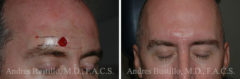 Reconstructive Surgery Before and After Photos in Miami, FL, Patient 15836