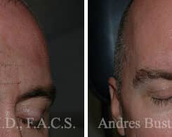 Reconstructive Surgery Before and After Photos in Miami, FL, Patient 15836